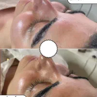 فشیال تخصصی،پاکسازی،درماپلینگ همراه با هدیه