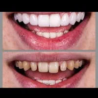 دندانپزشکی کامپوزیت لمینت|خدمات آرایشگری و زیبایی|قم, پردیسان|دیوار