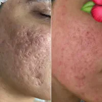مدل رایگان برای پوست جوش دار و اسکار و لک|خدمات آرایشگری و زیبایی|رشت, گلباغ نماز|دیوار