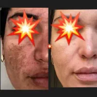کرم درخشان(قویترین کرم ضدلک و روشن کننده پوست)