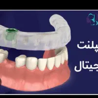 مرکزفوق تخصصی ایمپلنت دیجیتال/ایمپلنت فوری/بی درد|خدمات آرایشگری و زیبایی|مشهد, کوه سنگی|دیوار