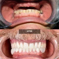 ایمپلنت با روکش هدیه 12.600 محدود|خدمات آرایشگری و زیبایی|تهران, ستارخان|دیوار