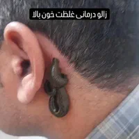 حجامت زالو درمانی بادکش گرم کلنیک شفا خانم باقری