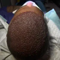 کاشت مو فرافر ، تراکم واقعی، خط رویش طبیعی، اقساطی
