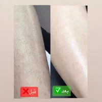 جشنواره لیزر موهای زائد سوپرانوایس تیتانیوم|خدمات آرایشگری و زیبایی|شیراز, معالی‌آباد|دیوار
