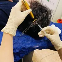 پی آر پی و مزوتراپی prp مو و ابرو|خدمات آرایشگری و زیبایی|اردبیل, |دیوار