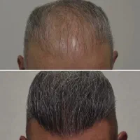 کاشت فوق تخصصی مو ، ابرو ، ریش