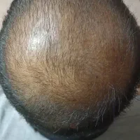 درمان قطعی ریزش مو و رویش مجدد|آرایشی، بهداشتی، درمانی|تهران, چیتگر شمالی|دیوار