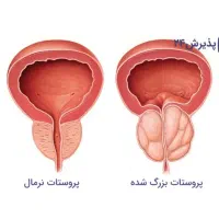 درمان پروستات و مشکلات اقایان