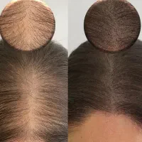 میکرواسکالپ تخصصی با جدیدترین متدvip|خدمات آرایشگری و زیبایی|مشهد, گوهرشاد|دیوار