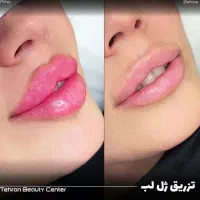 کلینیک/ جراحی بینی / ترمیم / تزریق ژل لب /|خدمات آرایشگری و زیبایی|تهران, سعادتآباد|دیوار