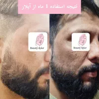 پوستت کدر و تیره شده نگران نباش با آیلار میدرخشی|آرایشی، بهداشتی، درمانی|میبد, |دیوار