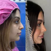 جراحی بینی بدون تامپون|خدمات آرایشگری و زیبایی|تهران, باشگاه نفت|دیوار