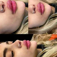 جشنواره تزریق ژل و بوتاکس و آموزش