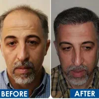 جشنواره کاشت تخصصی مو فول تراکم ۷ ملیون یک هفته|خدمات آرایشگری و زیبایی|تهران, ونک|دیوار
