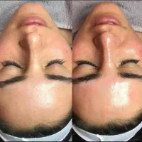 مدل فیشیال و پاکسازی پوست