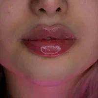 تزریق ژل لب و فیلر توسط پزشک زیبایی در منزل