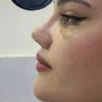 عمل بینی(قسطی)|خدمات آرایشگری و زیبایی|مسجد سلیمان, |دیوار