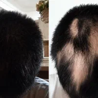 آلوپسی ، جنگ بدن با خودش