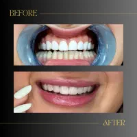 پکیج عصب کشی دندان فقط ۵۵۰۰