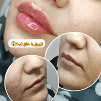 جشنواره تخفیف بوتاکس/ژل/آنزیم‌بینی/فیلرلب/فولفیس|خدمات آرایشگری و زیبایی|شیراز, زرهی|دیوار