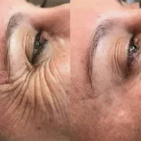 آف ویژه بالن وبوتاکس معده،ژل و بوتاکس وبفاروپلاستی|خدمات آرایشگری و زیبایی|اهواز, کیانپارس |دیوار