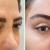 آف۲۰روز/۴۰٪لیفت شقیقه وجراح پلاستیک بدن/دستگاه پال|خدمات آرایشگری و زیبایی|مشهد, کوه سنگی|دیوار