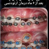 ارتودنسی ارزانتر از تعرفه نظام پزشکی،ایمپلنت فوری