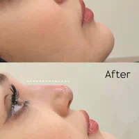 تزریق بوتاکس ژل فیلر|خدمات آرایشگری و زیبایی|تهران, صادقیه|دیوار