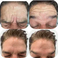 تزریق ژل و بوتاکس و مزوتراپی با تخفیفات ویژه یلدا