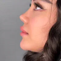 عمل بینی،لیپو ابدو لیفت،رفع غبغب،دایرکت ابرو،کاشت