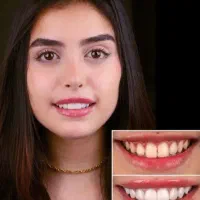 کامپوزیت.لمینت.پروتز.دست دندان|خدمات آرایشگری و زیبایی|تهران, مجیدیه|دیوار