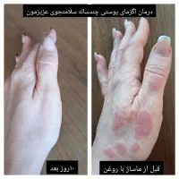 درمان مشکلات پوستی اگزما لک|آرایشی، بهداشتی، درمانی|سرخنکلاته, |دیوار