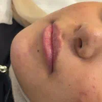 ژل و بوتاکس