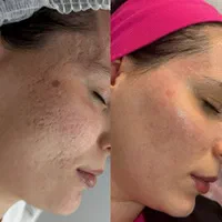 پاکسازی و فیشال /درمان جوش و لک و منافذباز|خدمات آرایشگری و زیبایی|کرمانشاه, |دیوار