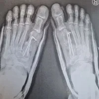 عمل افزایش قد و زیبایی ارتوپدی