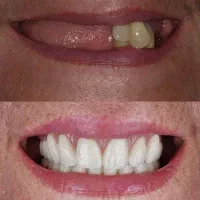 دندانپزشکی ایمپلنت اقساط ۲۴ ماهه|خدمات آرایشگری و زیبایی|تهران, میرداماد|دیوار