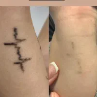 تخفیف ویژه پاک کردن تتو و روشن کننده نواحی تیره