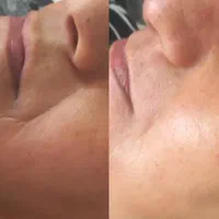 رفع غبغب رفع تیرگی رفع خطوط عمیق لبخند و دور چشم|خدمات آرایشگری و زیبایی|مشهد, هنرستان|دیوار