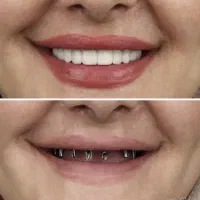 جشنواره تخفیف ایمپلنت در تبریز،با روکش فقط ۱۶‌تومن