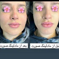 جشنواره تخفیف پی آر پی و ژل و بوتاکس|خدمات آرایشگری و زیبایی|شیراز, زرگری|دیوار