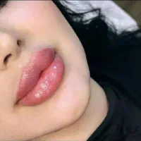 تزریق ژل لب و گونه و چانه.. (جشنواره)درمطب فقط500ت