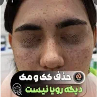 ریموکک ومک فشیال تخصصی صورت