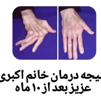 رماتیسم،نقرس ،ارتریت روماتوئید