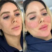 تزریق ژل بوتاکس فیلرجوانساز مزوتراپی فیشال