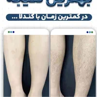 استخدام و آموزش لیزر کندلا لیزر رولی فشیال طب سنتی|استخدام درمانی، زیبایی، بهداشتی|اصفهان, سعادت‌آباد|دیوار