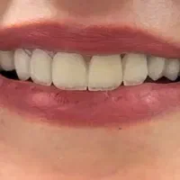 ایملنت ، لمینیت ، کامپوزیت در مطب شخصی|خدمات آرایشگری و زیبایی|تهران, نیاوران|دیوار