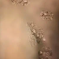 درمان ریشه ای زگیل و تبخال تناسلی
