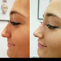 تزریق ژل لب .زاویه فک . بوتاکس. فیلر چانه.|خدمات آرایشگری و زیبایی|تهران, تهرانپارس غربی|دیوار