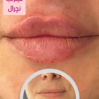 تزریق بوتاکس، ژل لب، زاویه سازی فقط سی سی ۱۸۰۰